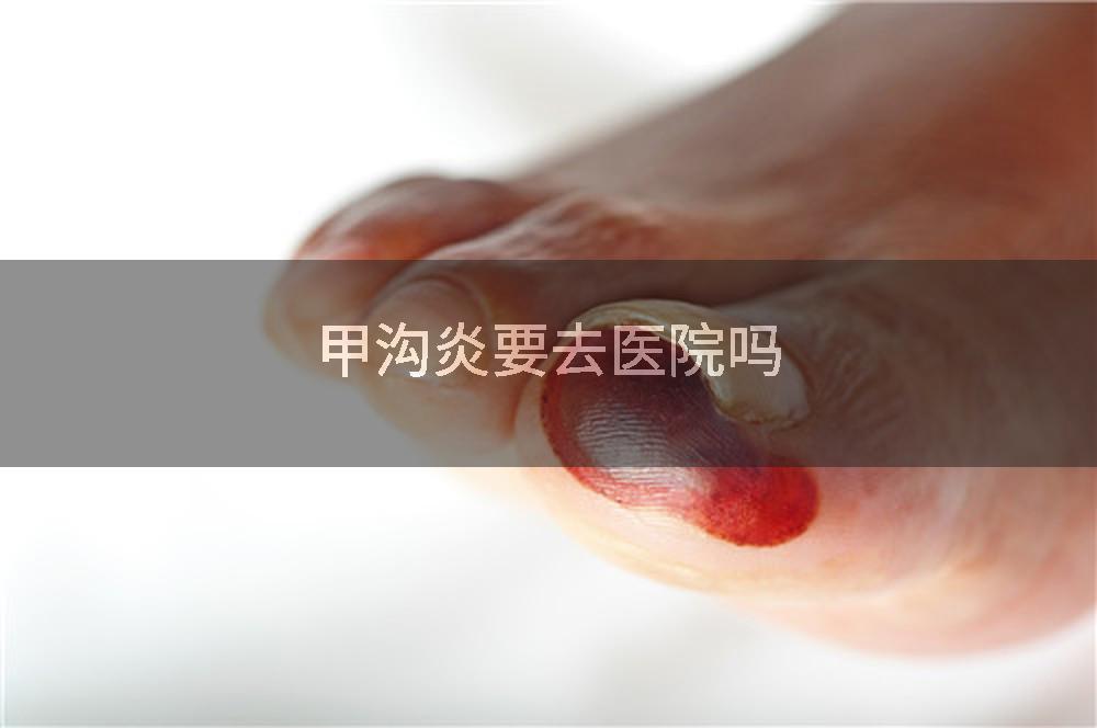 甲沟炎要去医院吗