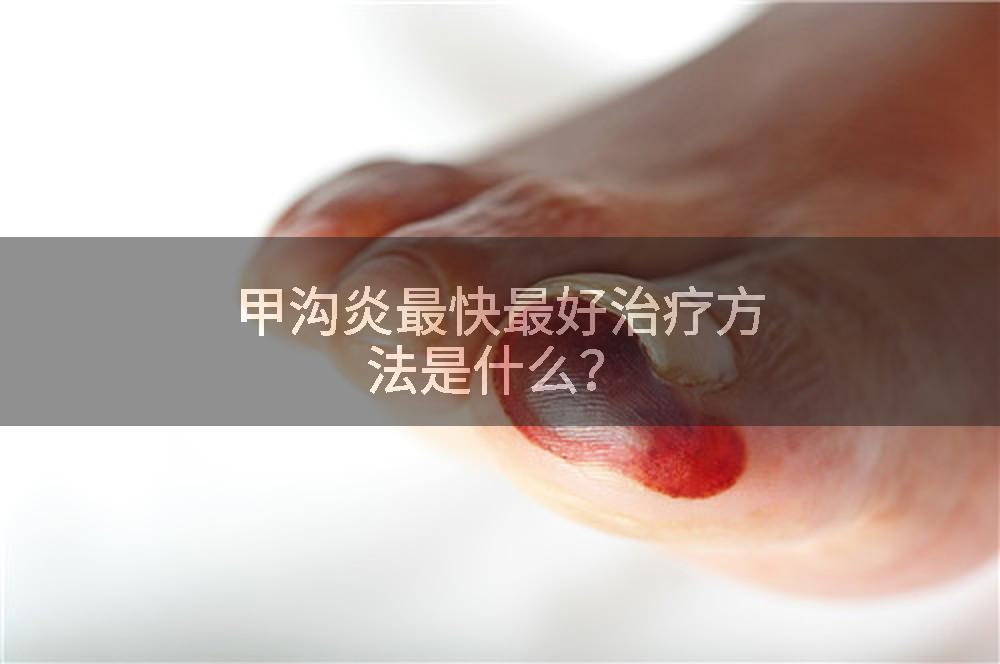 甲沟炎最快最好治疗方法是什么？