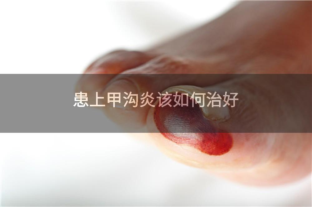 患上甲沟炎该如何治好