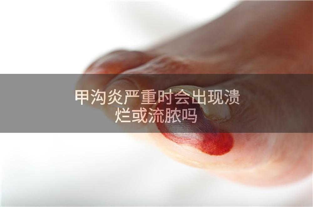 甲沟炎严重时会出现溃烂或流脓吗