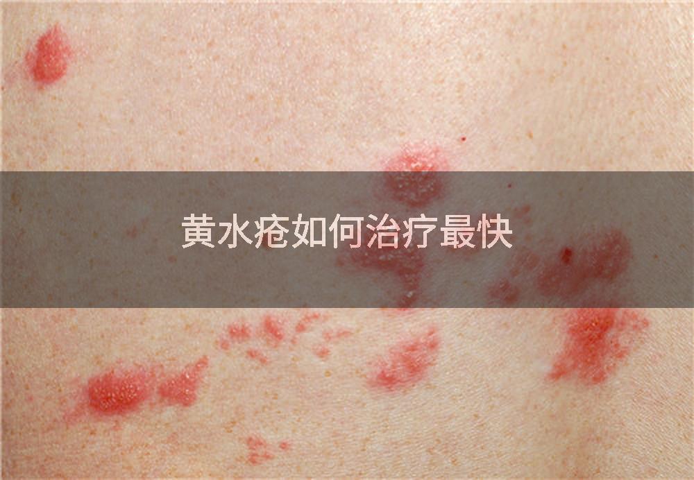 黄水疮如何治疗最快