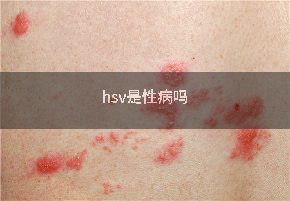 hsv是性病吗