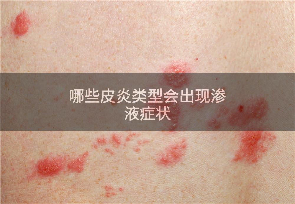 哪些皮炎类型会出现渗液症状