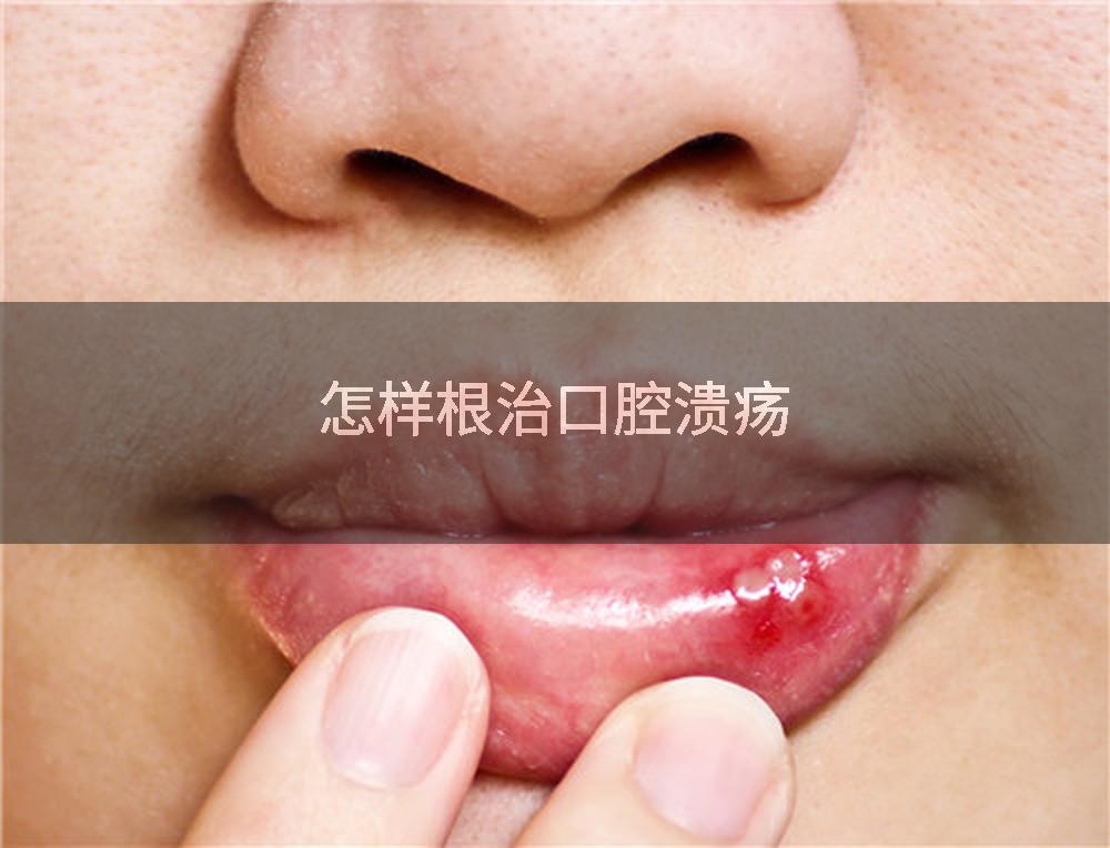 怎样根治口腔溃疡