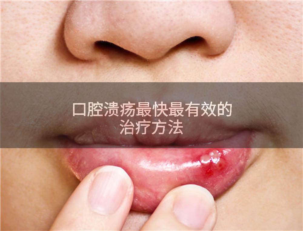 口腔溃疡最快最有效的治疗方法