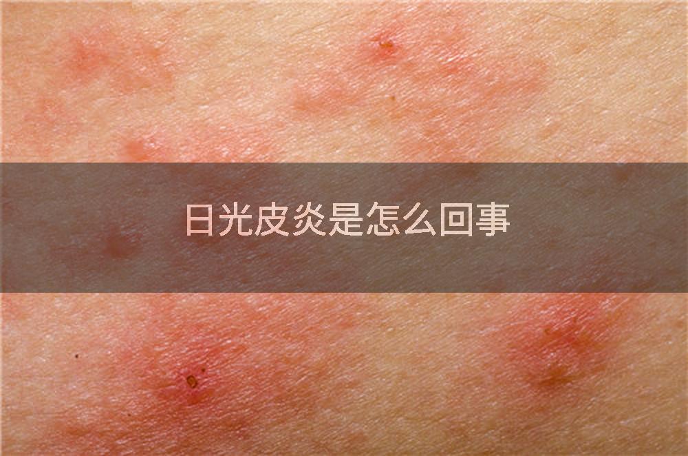 日光皮炎是怎么回事