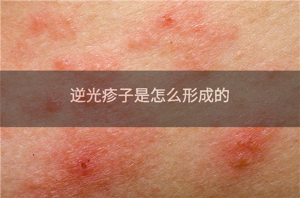逆光疹子是怎么形成的