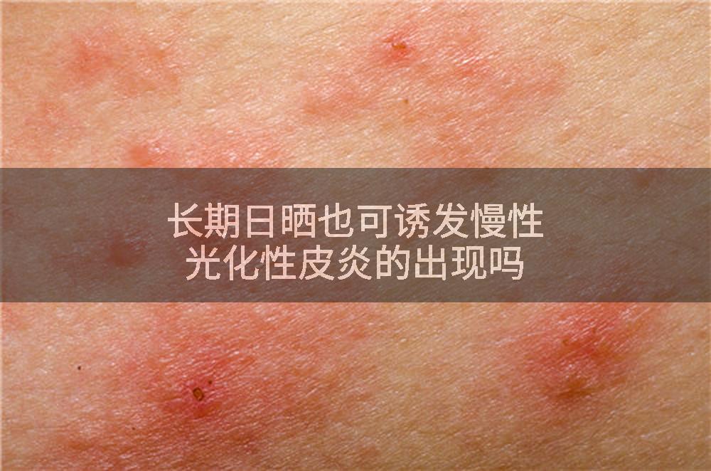 长期日晒也可诱发慢性光化性皮炎的出现吗