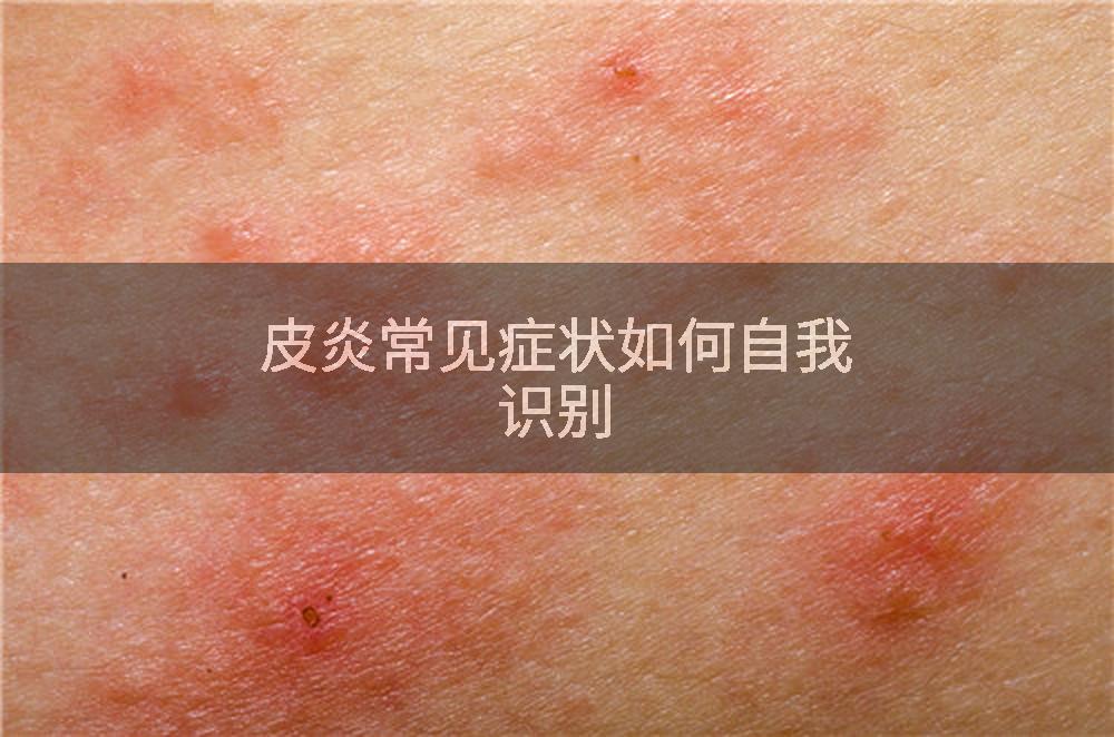 皮炎常见症状如何自我识别