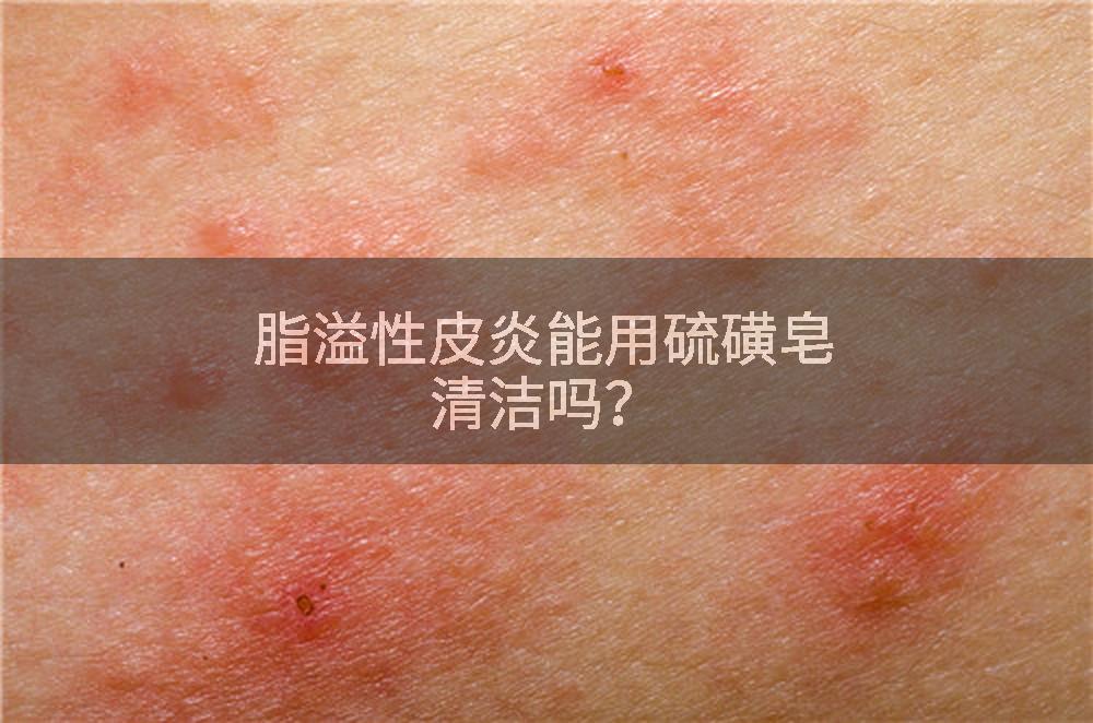 脂溢性皮炎能用硫磺皂清洁吗?