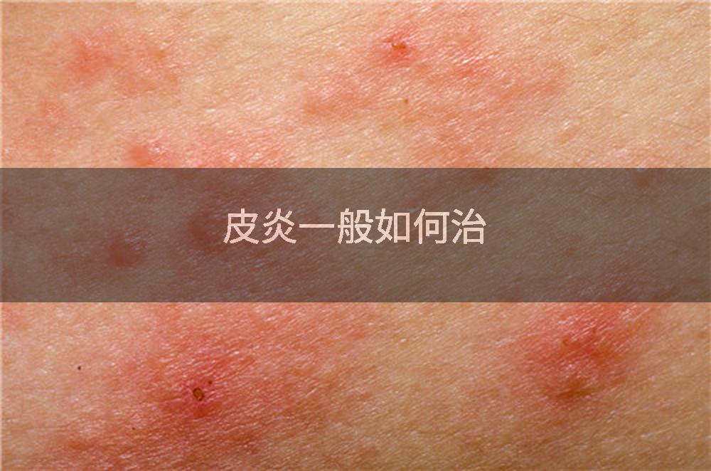 皮炎一般如何治