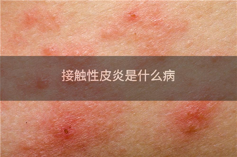 接触性皮炎是什么病