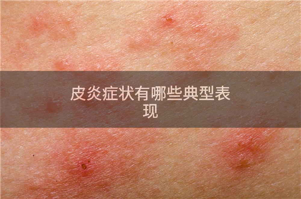 皮炎症状有哪些典型表现
