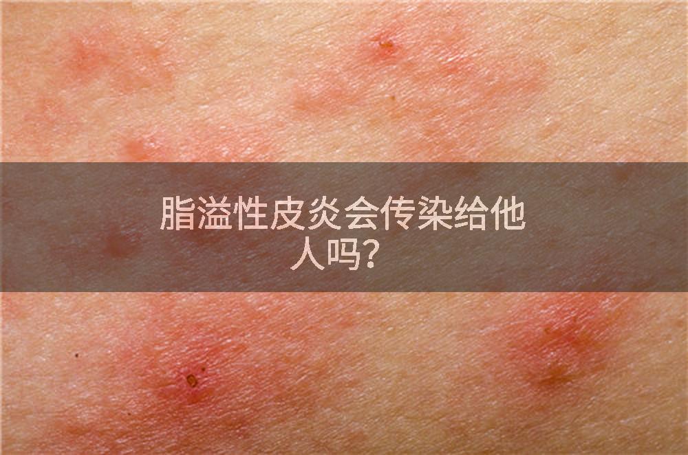 脂溢性皮炎会传染给他人吗?