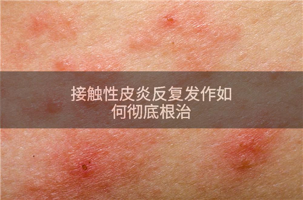 接触性皮炎反复发作如何彻底根治