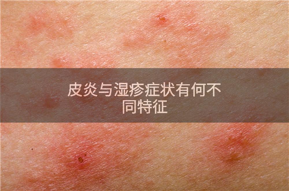 皮炎与湿疹症状有何不同特征