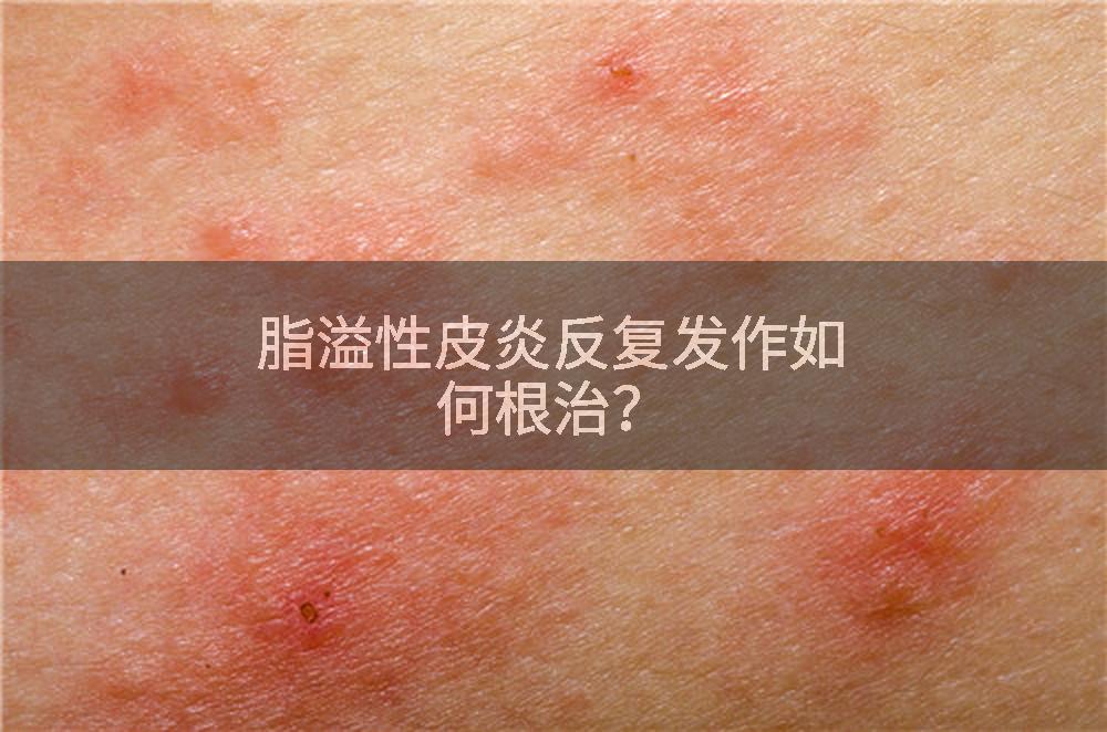 脂溢性皮炎反复发作如何根治？