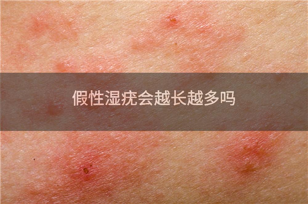 假性湿疣会越长越多吗