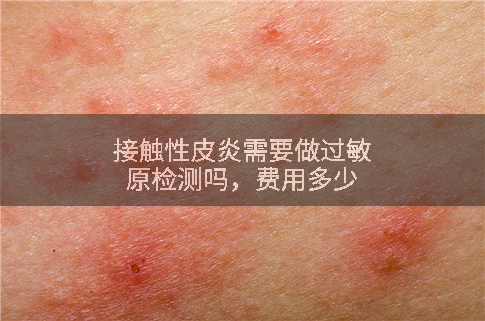 接触性皮炎需要做过敏原检测吗,费用多少