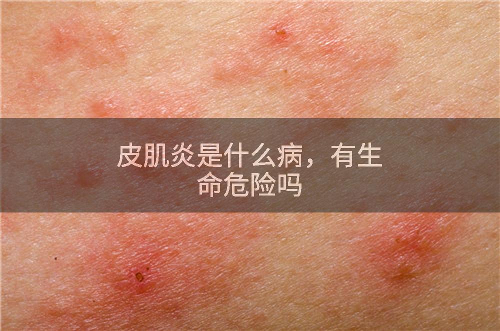 皮肌炎是什么病，有生命危险吗