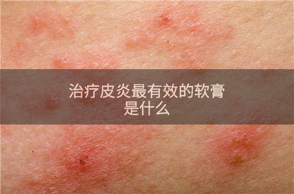 治疗皮炎最有效的软膏是什么