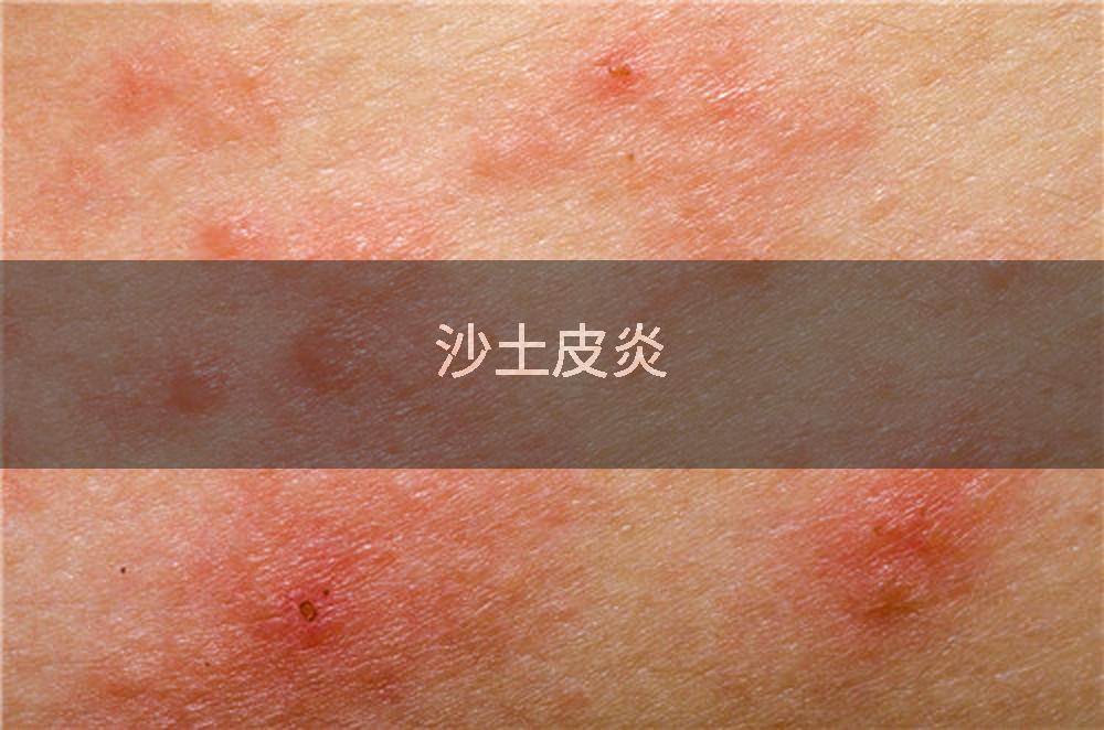 沙土皮炎