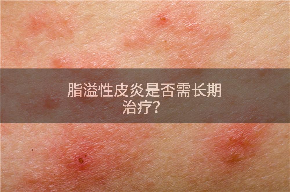 脂溢性皮炎是否需长期治疗？