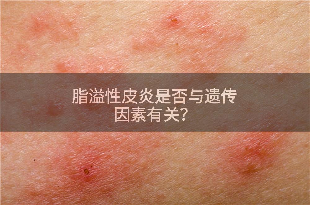 脂溢性皮炎是否与遗传因素有关？