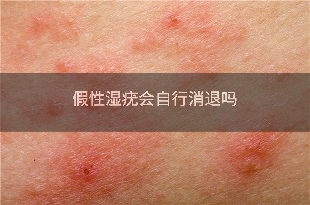 假性湿疣会自行消退吗