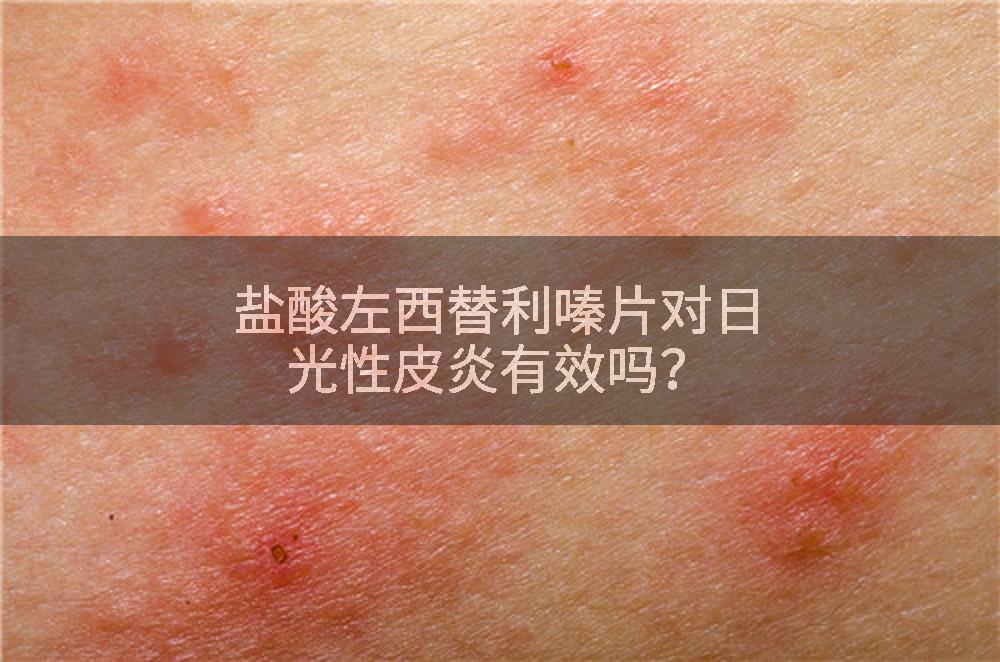 盐酸左西替利嗪片对日光性皮炎有效吗？