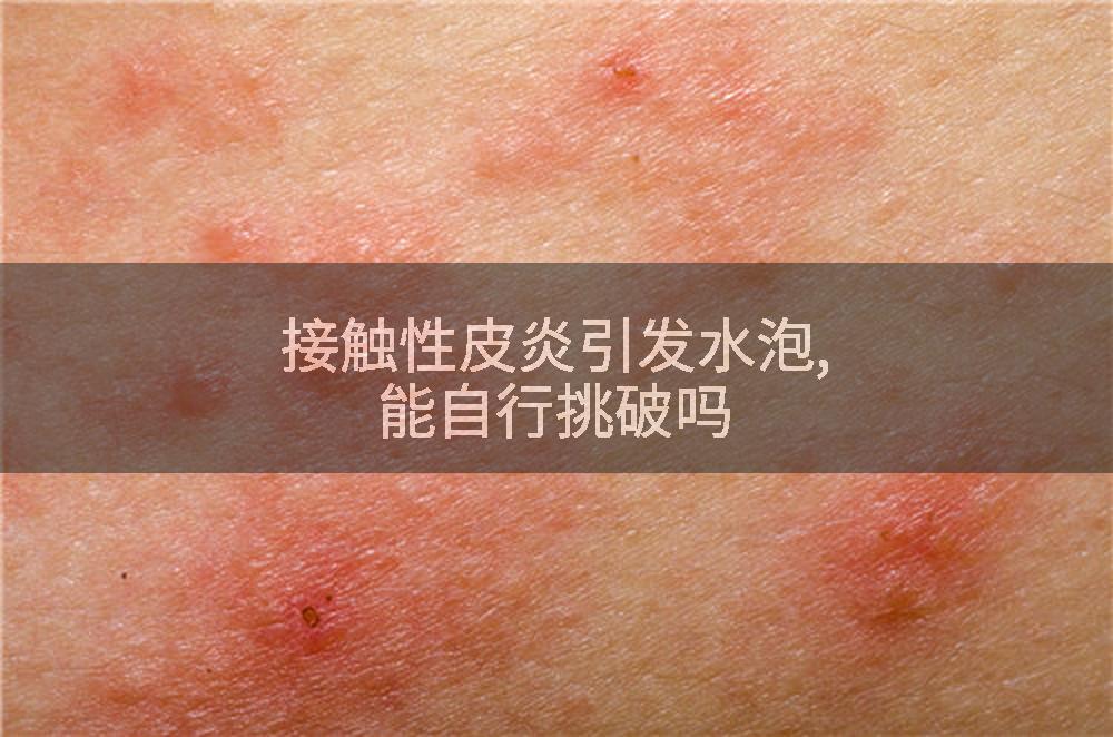 接触性皮炎引发水泡,能自行挑破吗