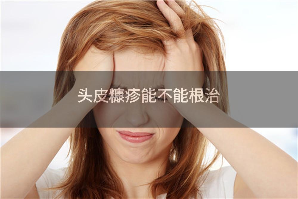 头皮糠疹能不能根治