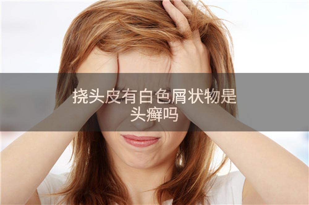 挠头皮有白色屑状物是头癣吗