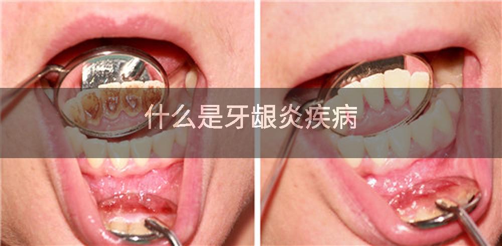 什么是牙龈炎疾病