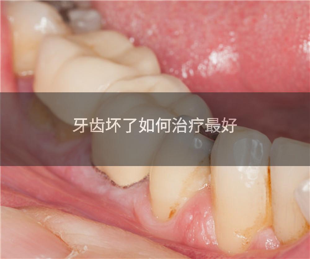 牙齿坏了如何治疗最好