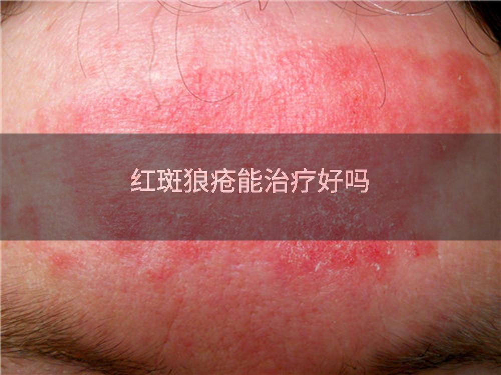 红斑狼疮能治疗好吗