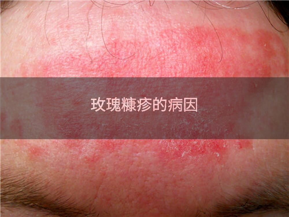 玫瑰糠疹的病因