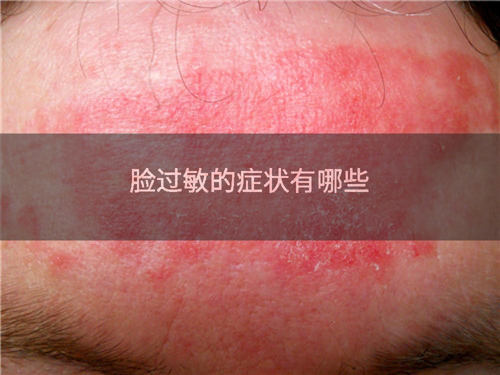 脸过敏的症状有哪些