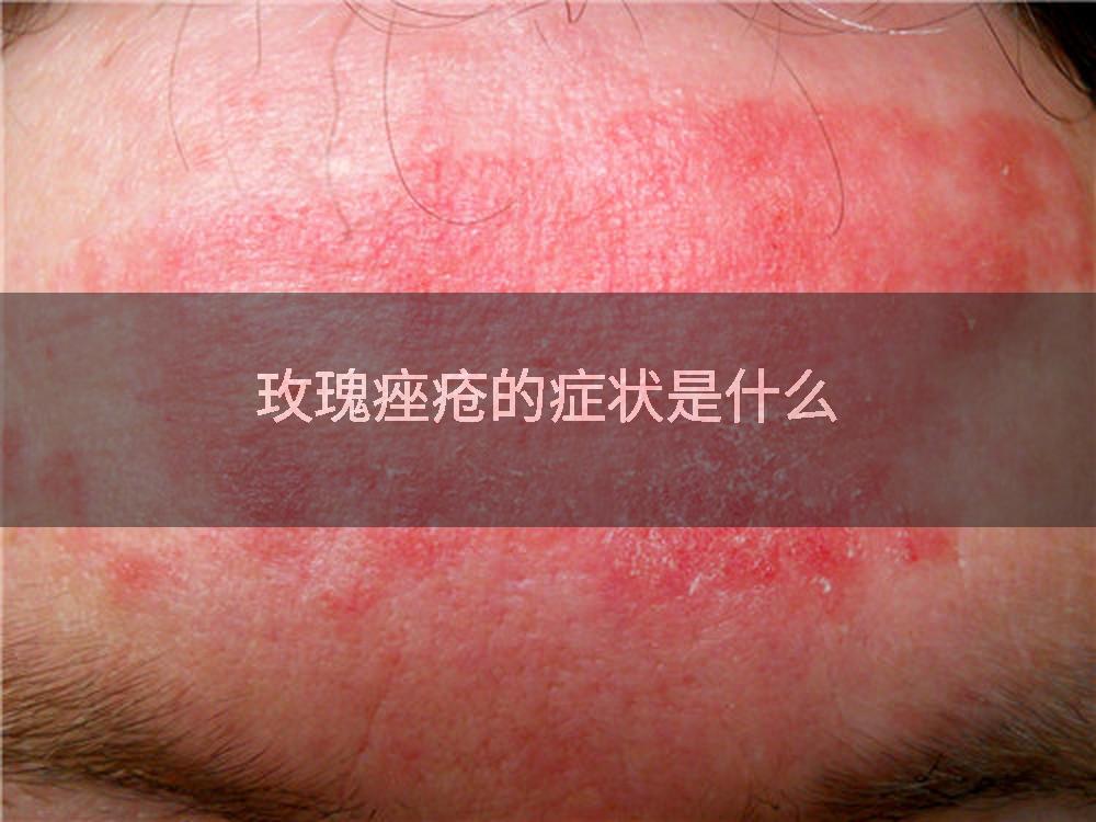 玫瑰痤疮的症状是什么