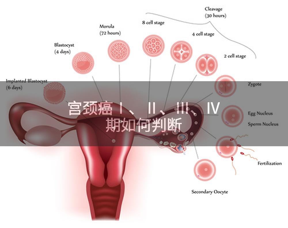 宫颈癌Ⅰ、Ⅱ、Ⅲ、Ⅳ期如何判断