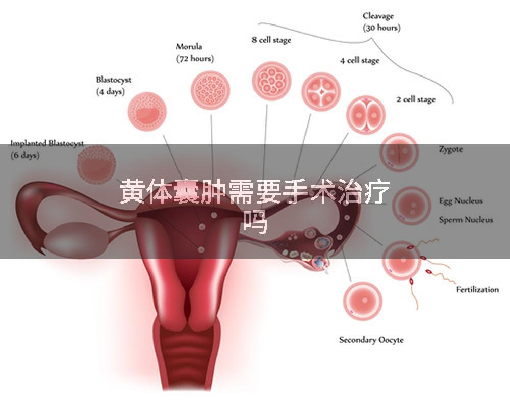 黄体囊肿需要手术治疗吗