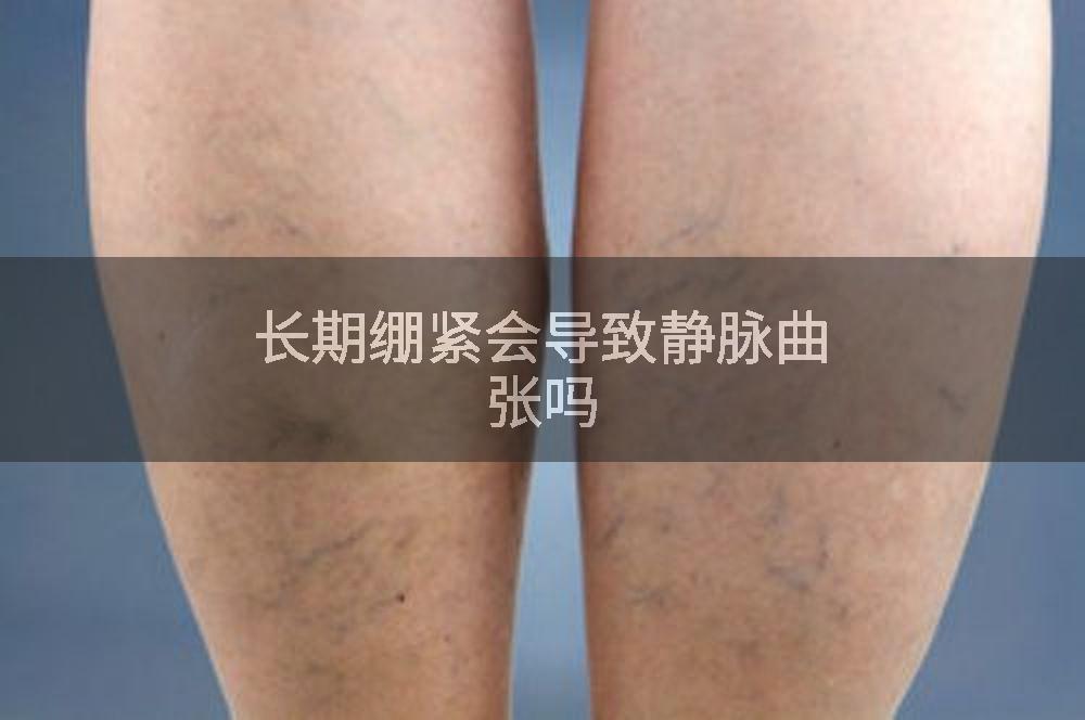 长期绷紧会导致静脉曲张吗