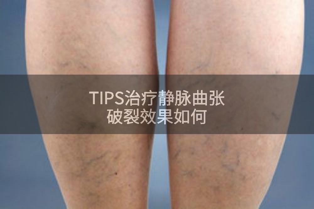 TIPS治疗静脉曲张破裂效果如何