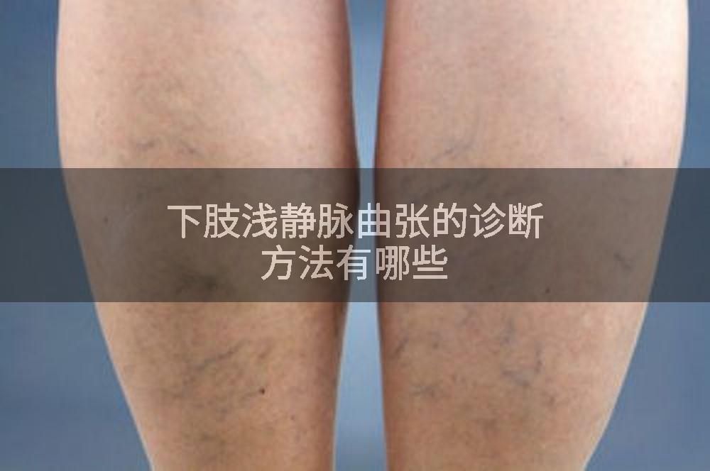下肢浅静脉曲张的诊断方法有哪些