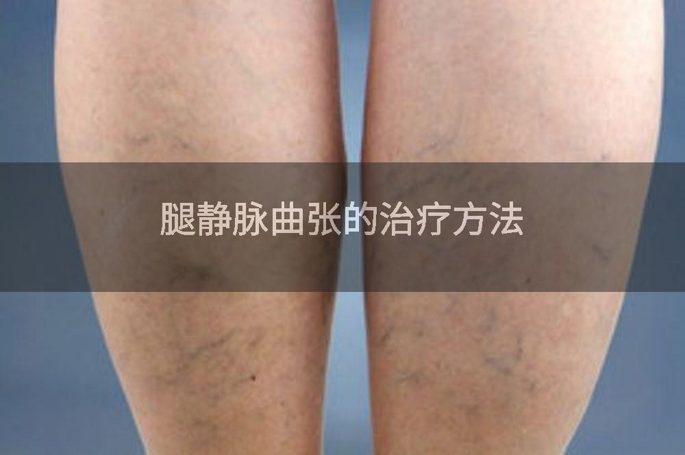 腿静脉曲张的治疗方法