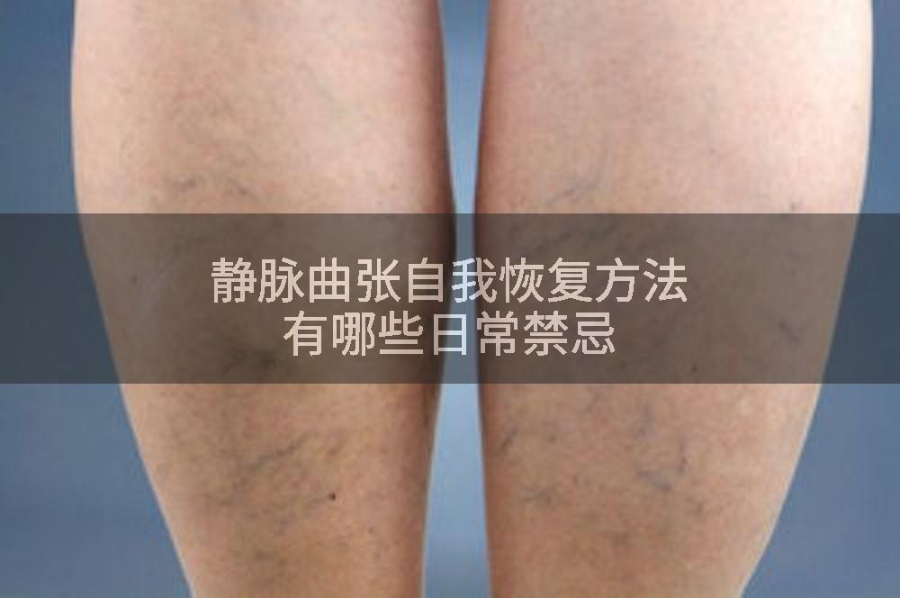 静脉曲张自我恢复方法有哪些日常禁忌