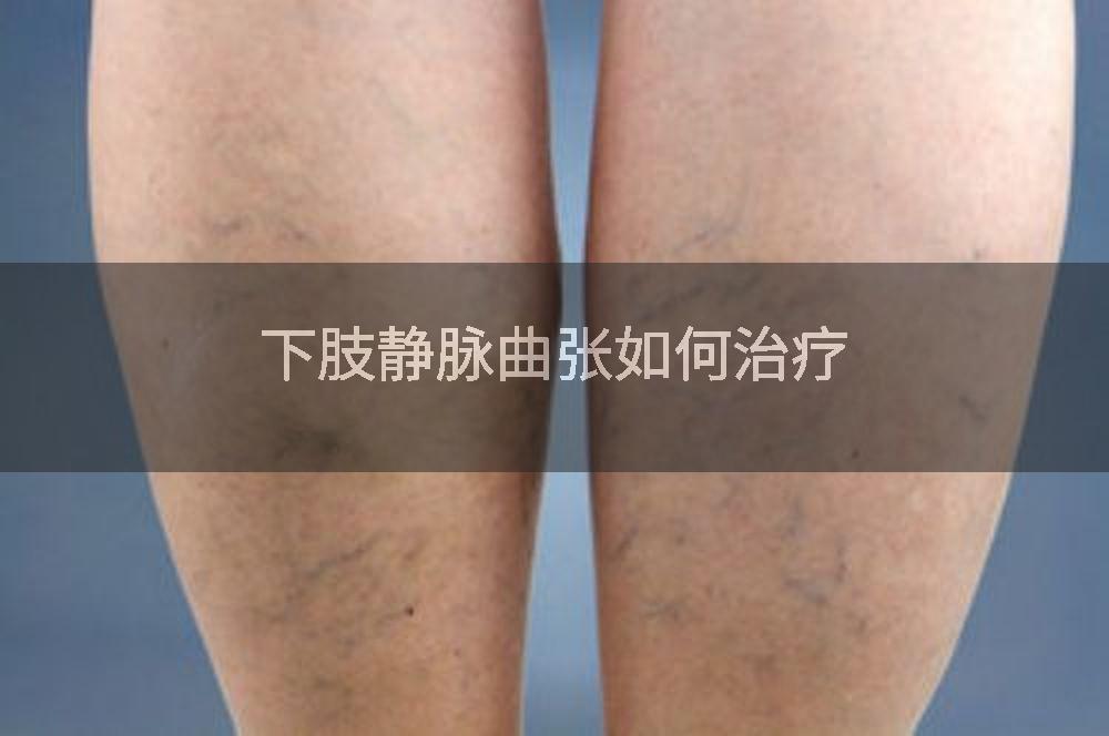 下肢静脉曲张如何治疗