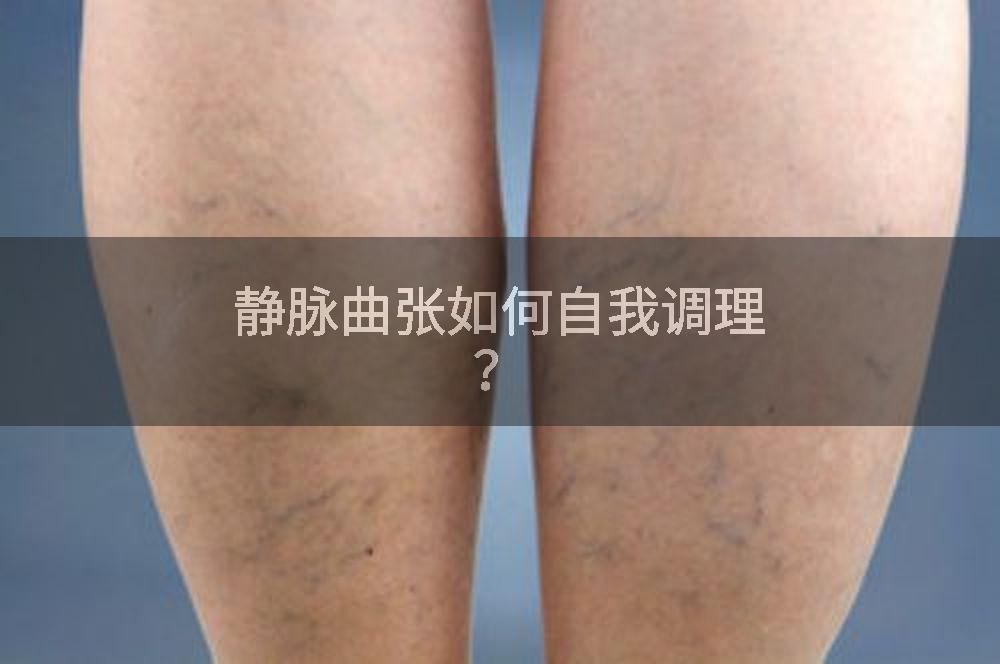 静脉曲张如何自我调理？