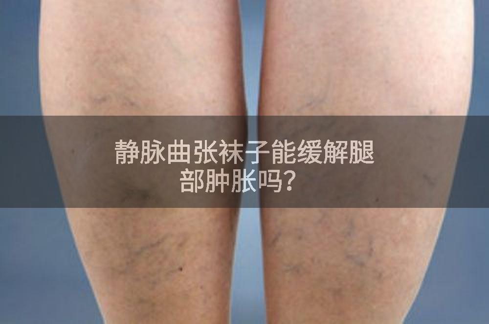 静脉曲张袜子能缓解腿部肿胀吗？