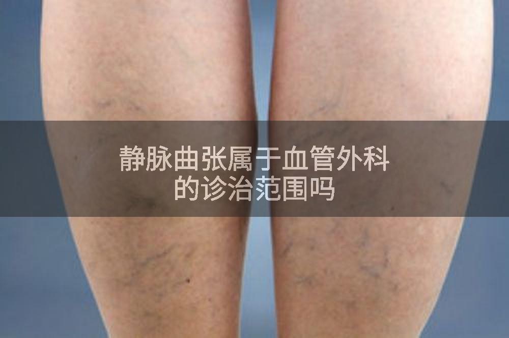 静脉曲张属于血管外科的诊治范围吗